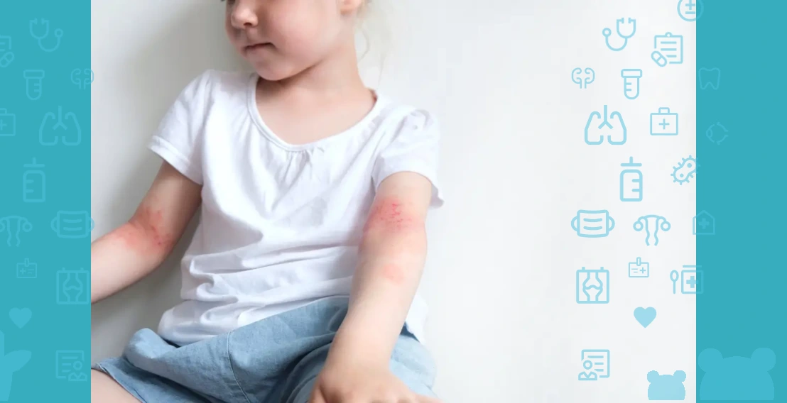 hives in children