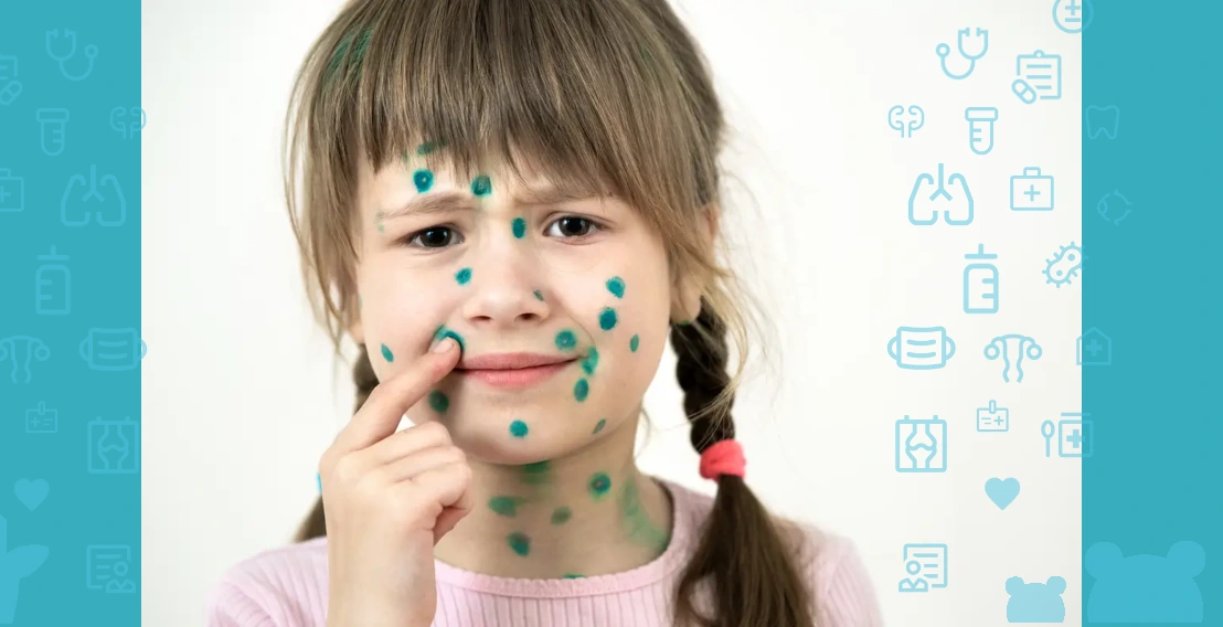 chickenpox in children